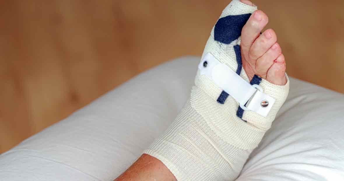 hallux valgus