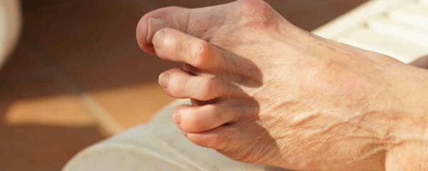 hallux valgus