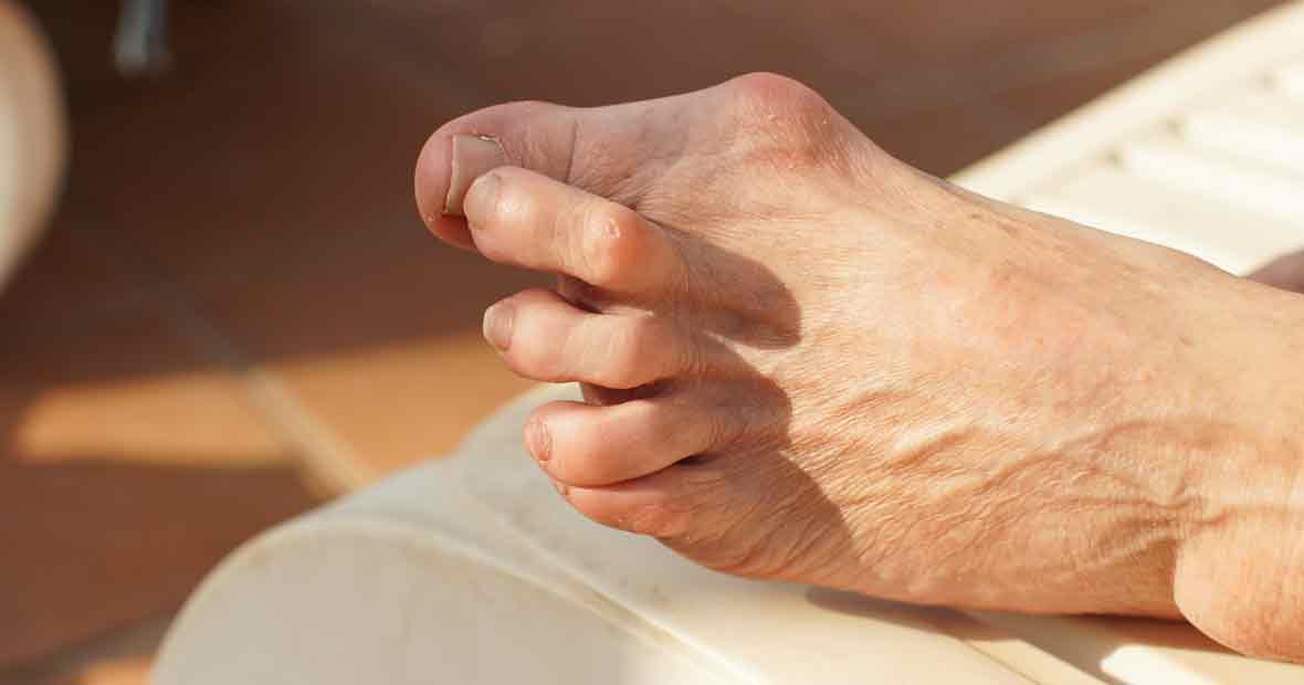 hallux valgus